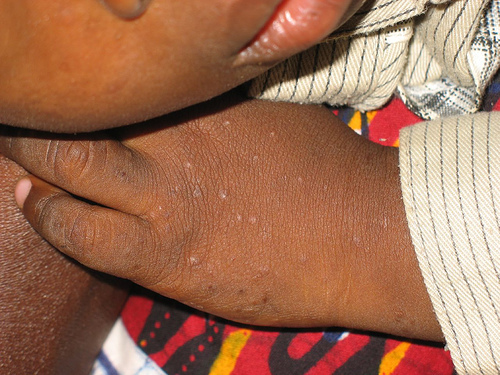 hiv rash hands